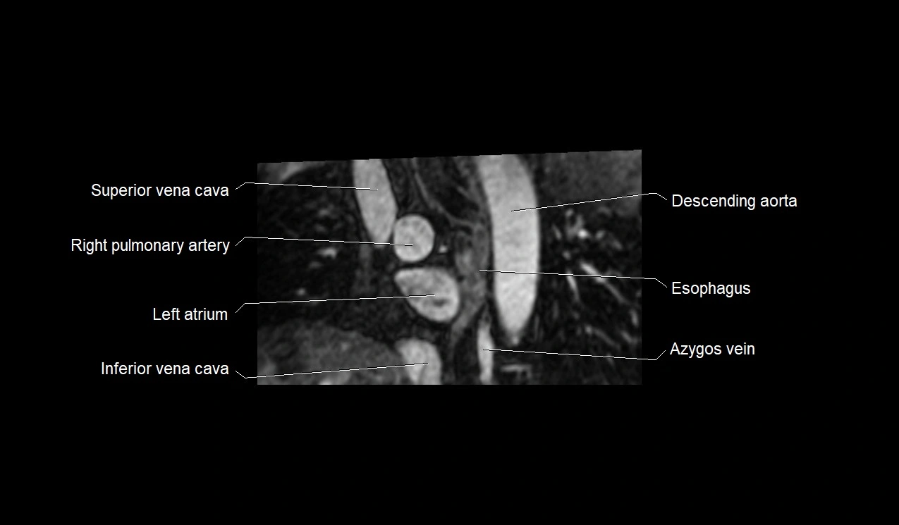 MRI heart and coronary arteries short axis anatomy image 4.webp